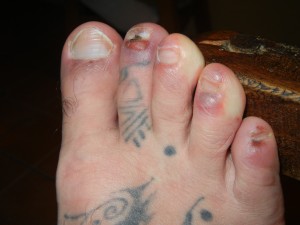 toe-blisters-300x225.jpg