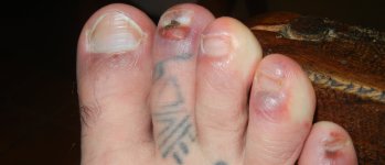 traveler-feet-blisters-e1324328017537.jpg
