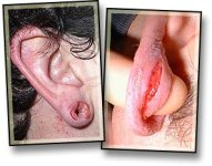 Earlobe_Tearing-1.jpg