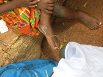 Guinea-Worm.jpg