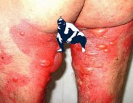 Scabies.jpg